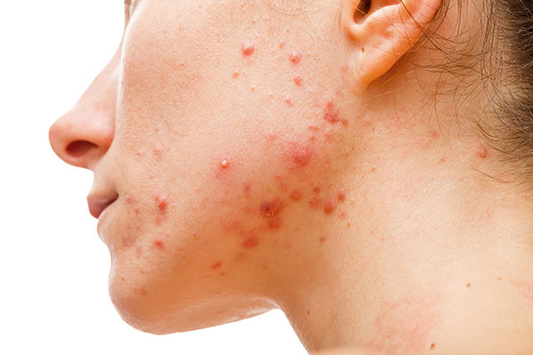 acne Terapia dell'acne - Dott. Aligi Franchi