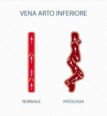 Vena arto inferiore - Dott. Aligi Franchi